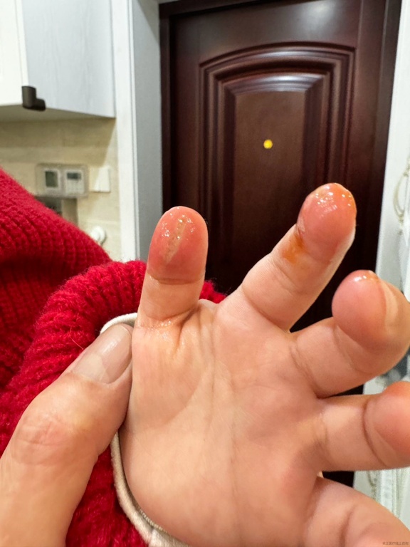 连续两娃被烫伤 家长:“仙女棒”这么“凶”?医生:小心春节高发 连续两娃被烫伤 家长:“仙女棒”这么“凶”?医生:小心春节高发