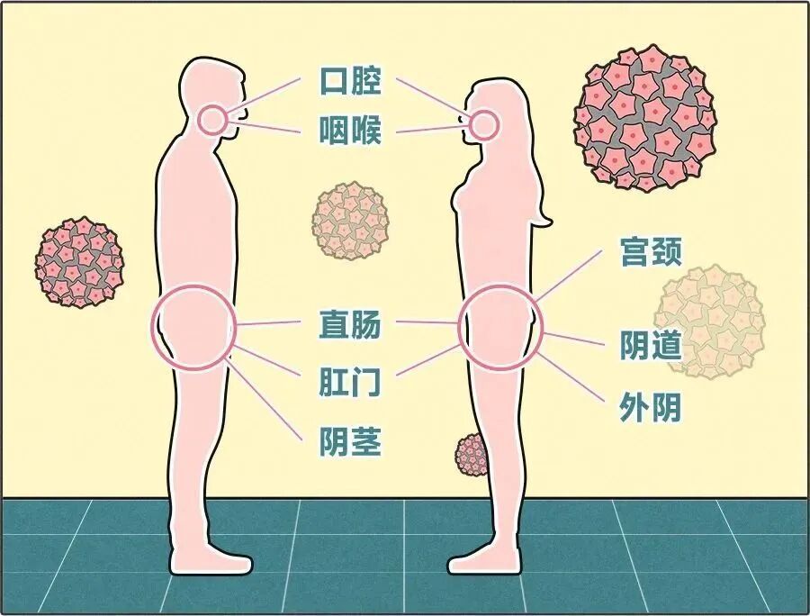 男性终身感染HPV几率达90%!且没有明显症状… 男性终身感染HPV几率达90%!且没有明显症状…