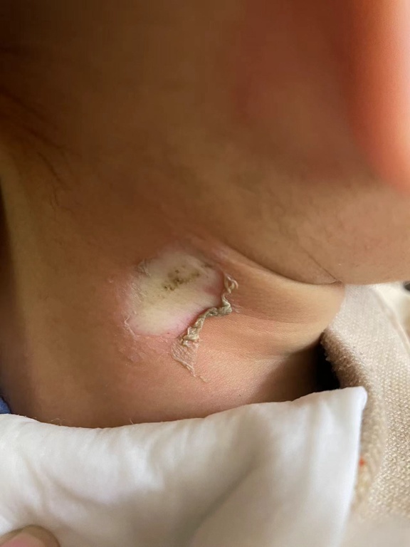 连续两娃被烫伤 家长:“仙女棒”这么“凶”?医生:小心春节高发 连续两娃被烫伤 家长:“仙女棒”这么“凶”?医生:小心春节高发