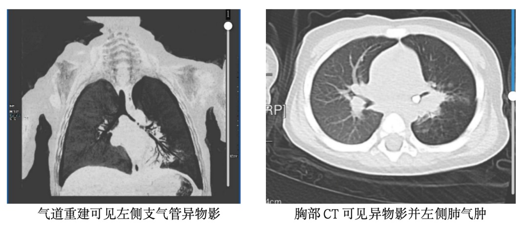 1岁宝宝误呛乳牙,反复肺炎50天!春节气道异物防护指南,家长必看! 1岁宝宝误呛乳牙,反复肺炎50天!春节气道异物防护指南,家长必看!