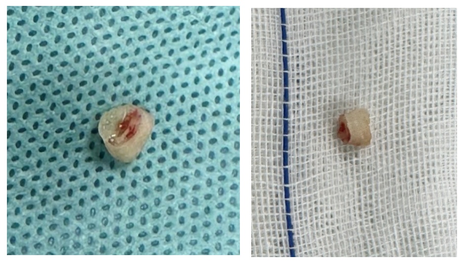 1岁宝宝误呛乳牙,反复肺炎50天!春节气道异物防护指南,家长必看! 1岁宝宝误呛乳牙,反复肺炎50天!春节气道异物防护指南,家长必看!