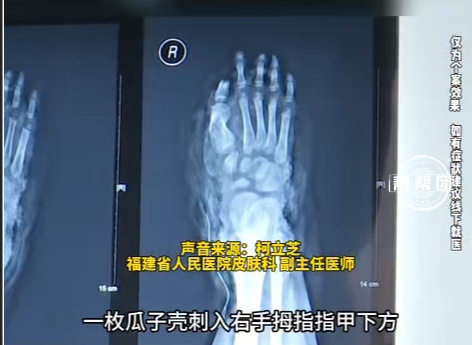 8岁女童被瓜子壳刺伤，竟导致甲下化脓手指变形！医生提醒
