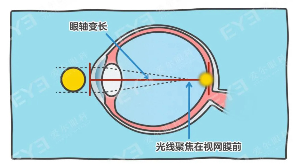 寒假用眼增多,专家支招:科学防控近视,别让假期成孩子视力“下滑期” 寒假用眼增多,专家支招:科学防控近视,别让假期成孩子视力“下滑期”