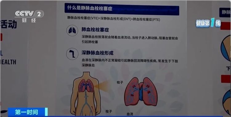 春运路上,警惕“经济舱综合征”! 春运路上,警惕“经济舱综合征”!