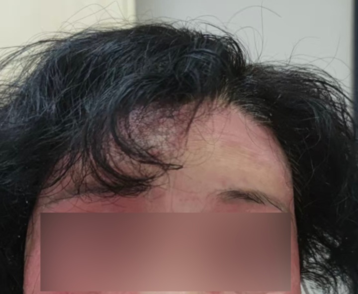 糟心！杭州阿姨这个春节无奈剃光头，“没脸见人了……”快提醒家人