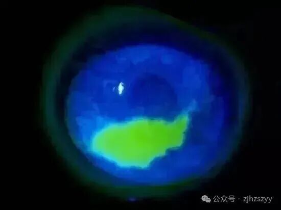 糟心！杭州阿姨这个春节无奈剃光头，“没脸见人了……”快提醒家人