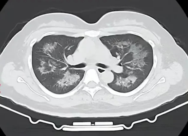 每天用2次定妆喷雾，近半年后22岁女主播确诊间质性肺炎