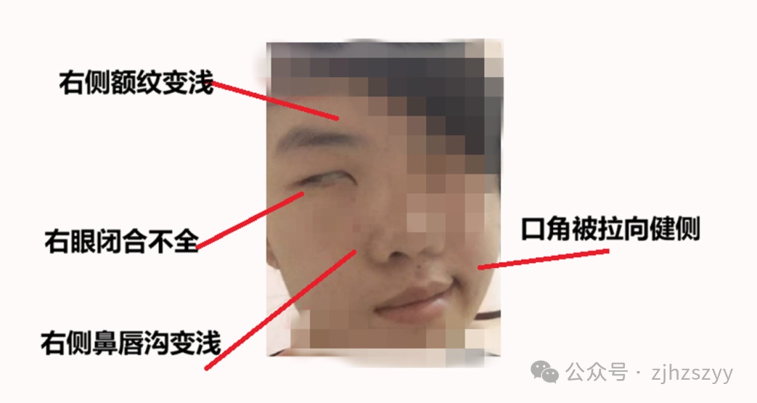 假期疯玩数日 19岁小伙一夜变"面瘫"