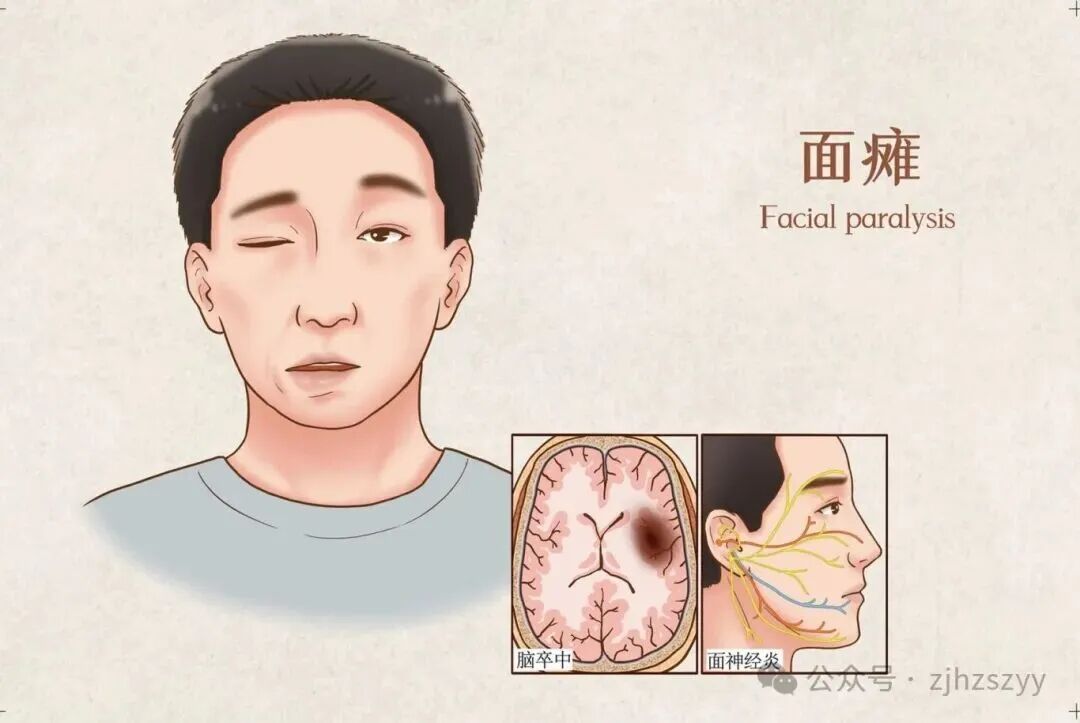 假期疯玩数日 19岁小伙一夜变"面瘫"