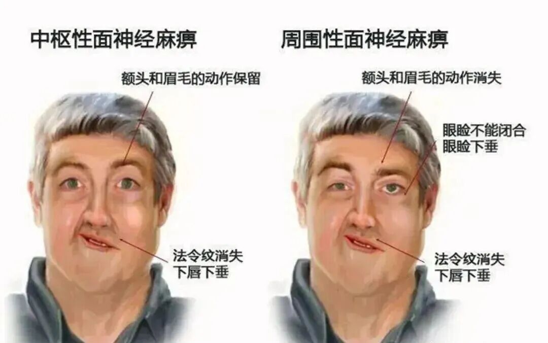 假期疯玩数日，19岁小伙一夜变“面瘫”！近期高发，医生提醒→