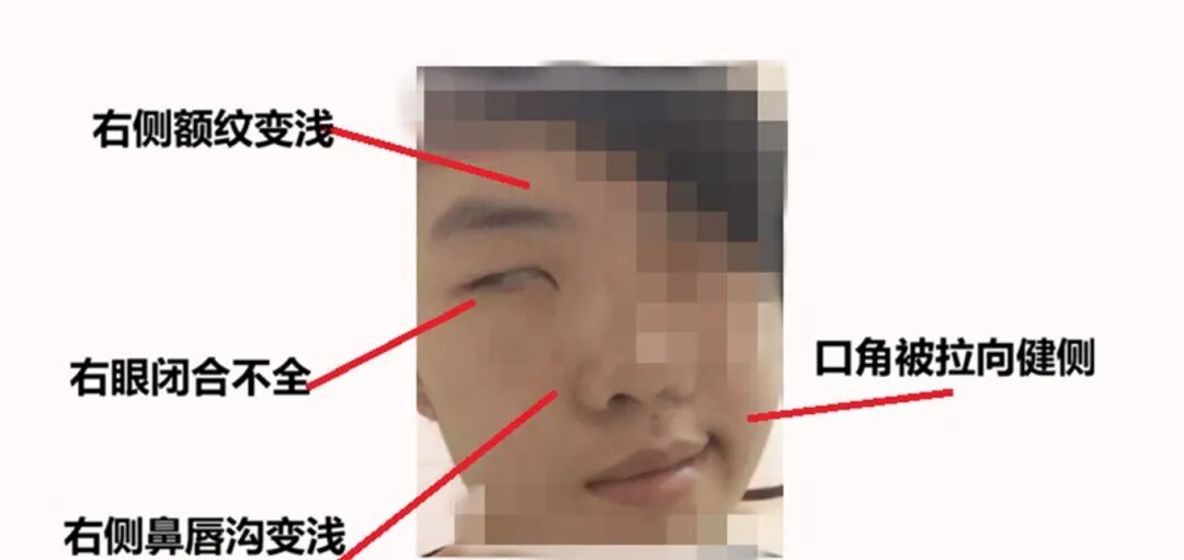 假期疯玩数日，19岁小伙一夜变“面瘫”！近期高发，医生提醒→