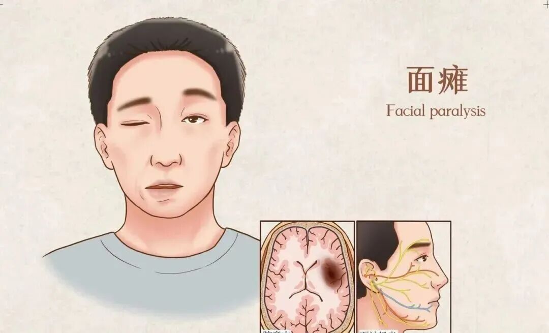 假期疯玩数日，19岁小伙一夜变“面瘫”！近期高发，医生提醒→