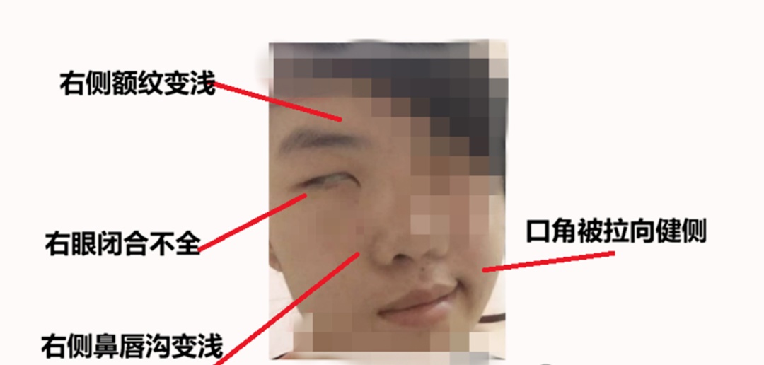 假期疯玩数日，19岁小伙一夜之间脸歪了！警惕这些刺激