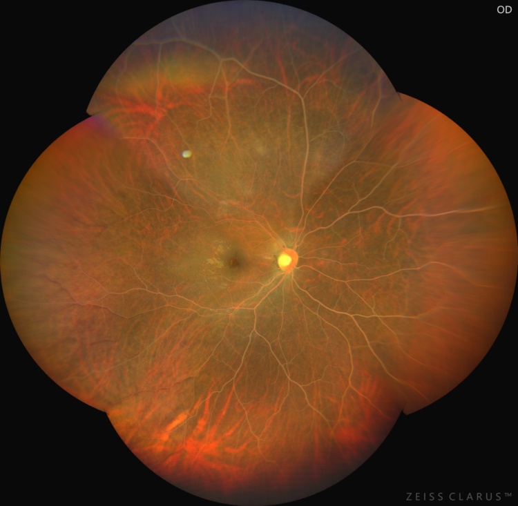 紧急就诊！眼底变“奶油色”，血脂直接爆表……只因常吃的它