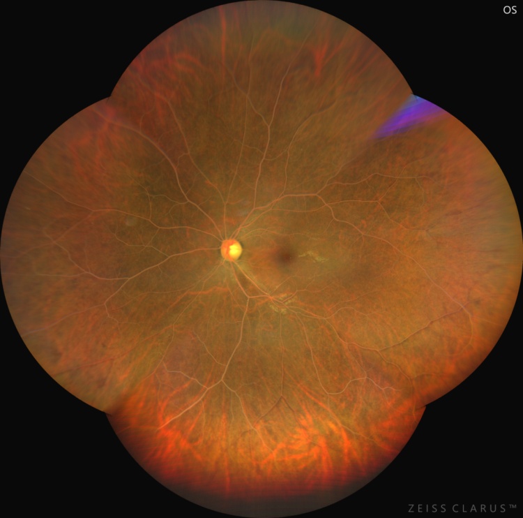 紧急就诊！眼底变“奶油色”，血脂直接爆表……只因常吃的它