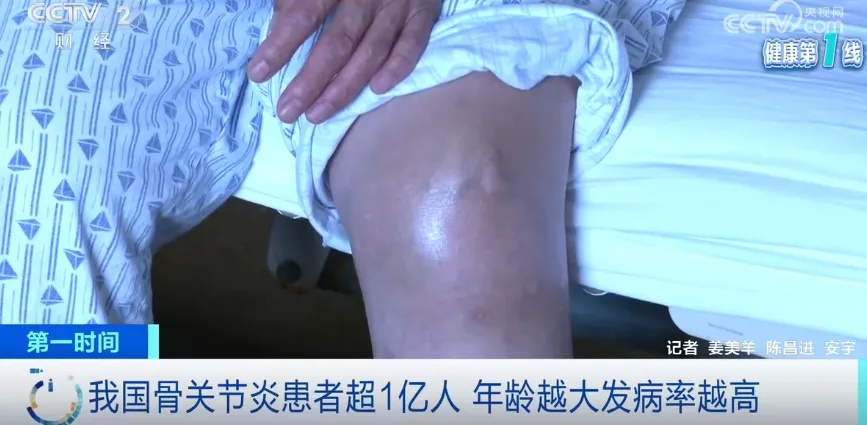 国内患者已超1亿人!被称为头号致残性疾病!医生紧急提醒 国内患者已超1亿人!被称为头号致残性疾病!医生紧急提醒