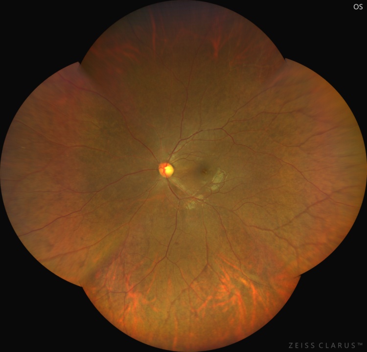 紧急就诊！眼底变“奶油色”，血脂直接爆表……只因常吃的它