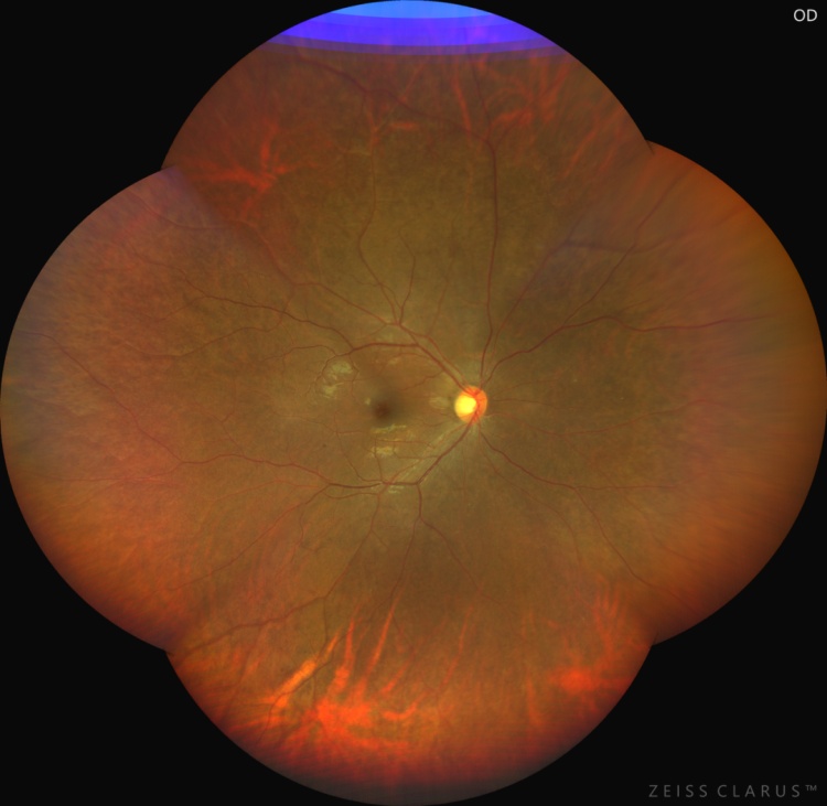 紧急就诊！眼底变“奶油色”，血脂直接爆表……只因常吃的它