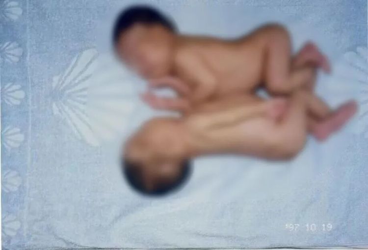 连体女婴分离28年后，当妈妈了！回到当年接受手术的医院生产
