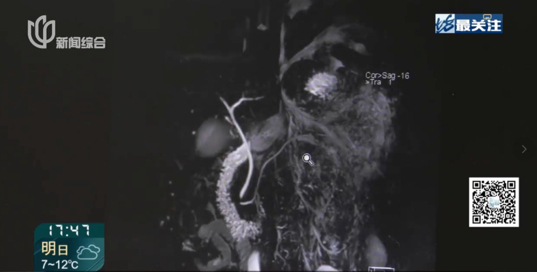 瑞金医生紧急提醒!有人连夜赶回上海,有人9天假期住院7天… 瑞金医生紧急提醒!有人连夜赶回上海,有人9天假期住院7天…