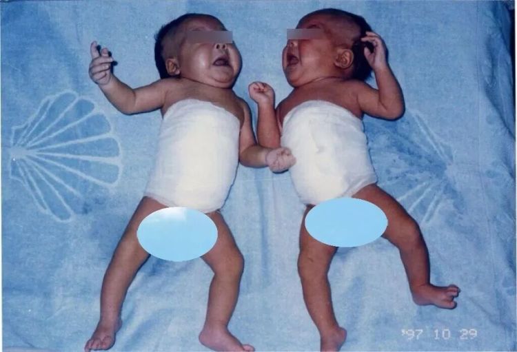 连体女婴分离28年后，当妈妈了！回到当年接受手术的医院生产