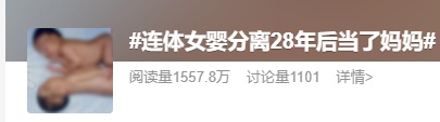 连体女婴分离28年后，当妈妈了！回到当年接受手术的医院生产