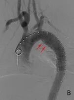“疼死我了……”深夜男子血管“撕裂”，被紧急送进抢救室