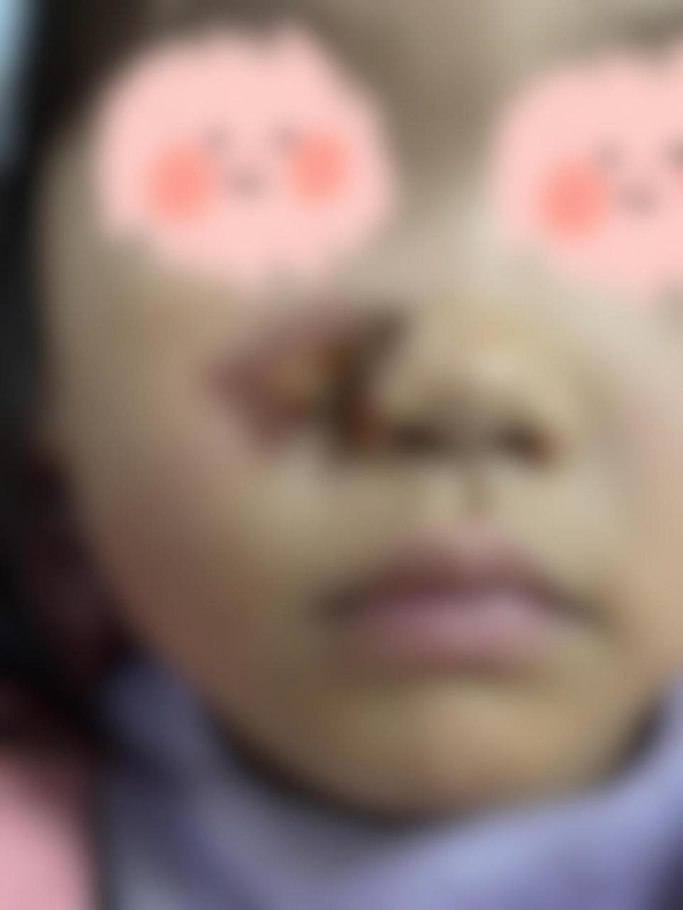 4岁女童看烟花时被鞭炮溅伤面部,医生:坚决杜绝偏方 4岁女童看烟花时被鞭炮溅伤面部,医生:坚决杜绝偏方