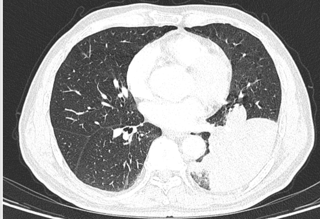 老人咳嗽半月，竟是1.6厘米鱼骨藏在肺里！