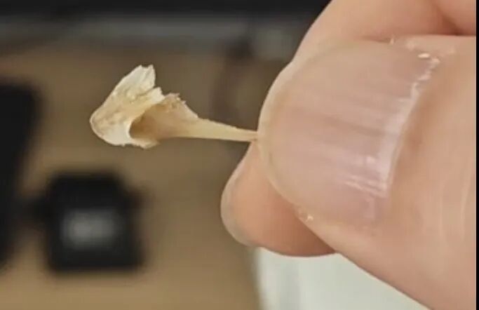 老人咳嗽半月，竟是1.6厘米鱼骨藏在肺里！