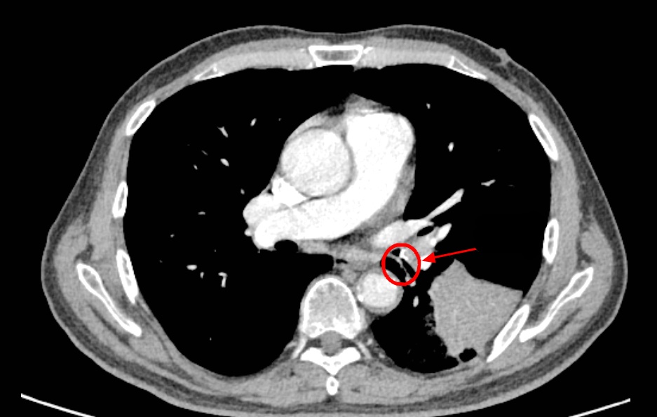 老人咳嗽半月，竟是1.6厘米鱼骨藏在肺里！