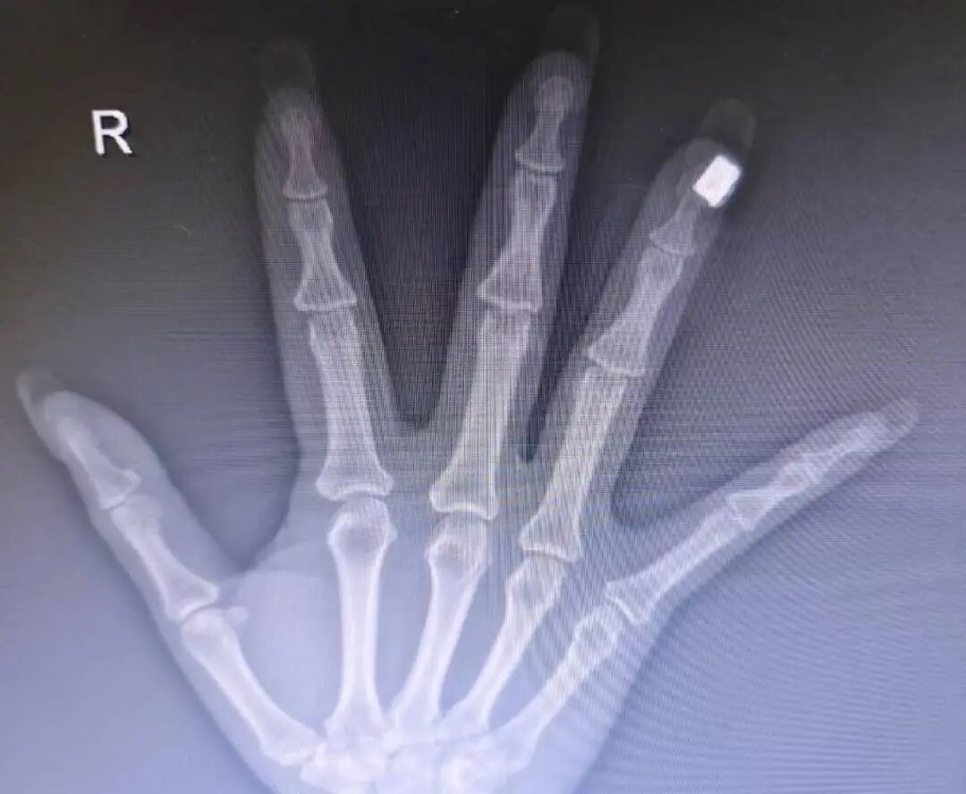 28岁女子心跳骤停送医抢救，没想到医生先叫来了美甲师