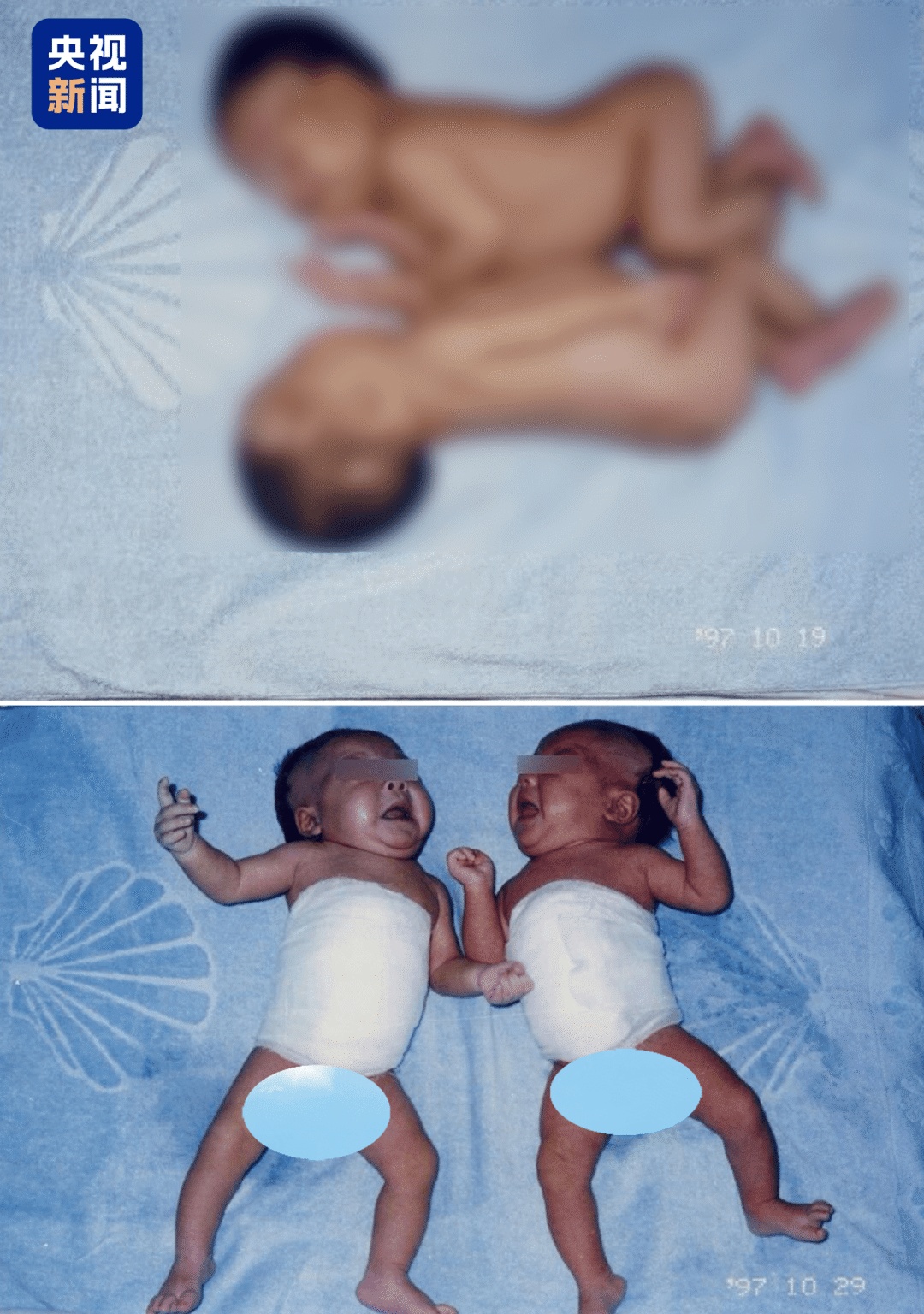 连体女婴分离28年后，当妈妈了！