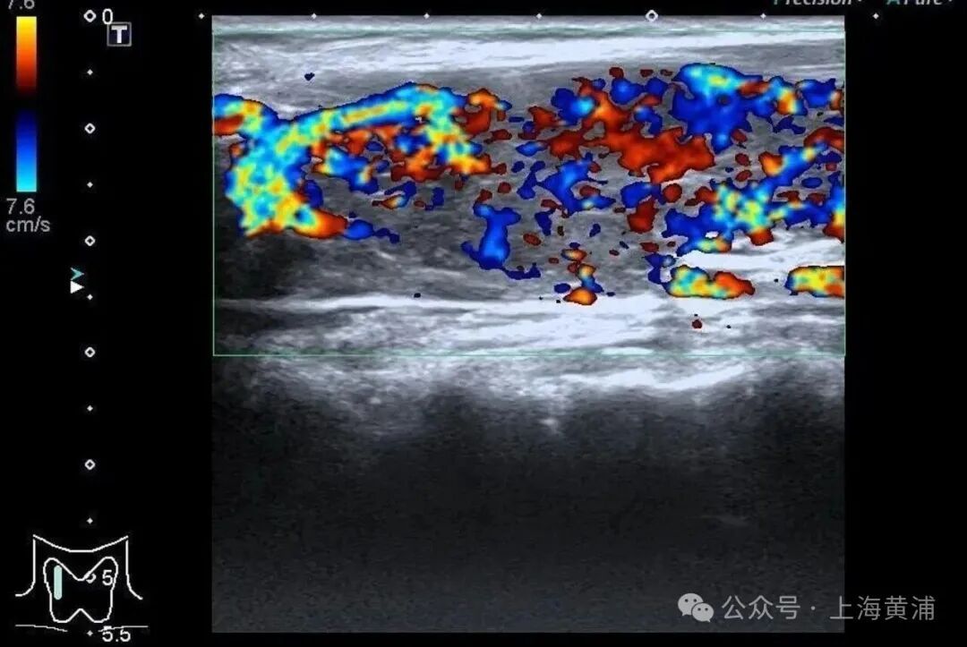 32岁女子突然不对劲,心脏、肝脏等器官全部罢工!想想就后怕 32岁女子突然不对劲,心脏、肝脏等器官全部罢工!想想就后怕