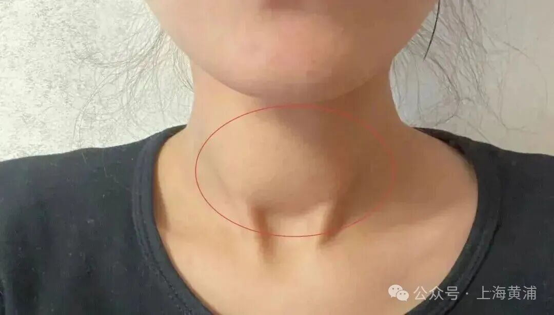 32岁女子突然不对劲,心脏、肝脏等器官全部罢工!想想就后怕 32岁女子突然不对劲,心脏、肝脏等器官全部罢工!想想就后怕