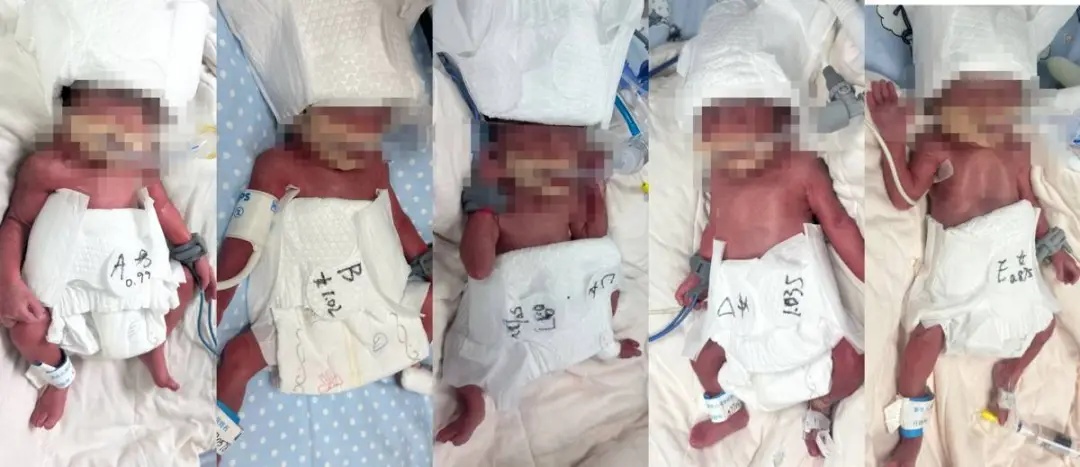 5胞胎（1男4女）顺利出生