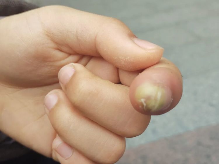 警惕！11岁女孩手指红肿疼痛，医生：再晚就要截指了！