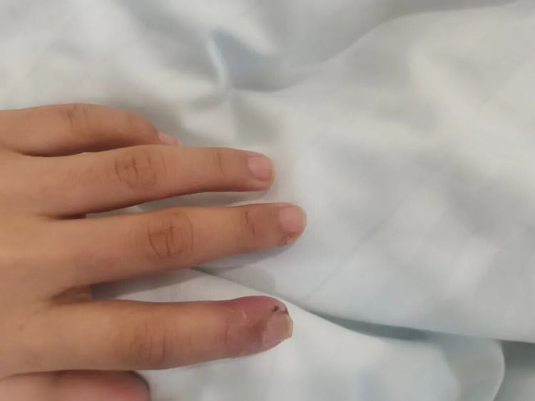 警惕！11岁女孩手指红肿疼痛，医生：再晚就要截指了！