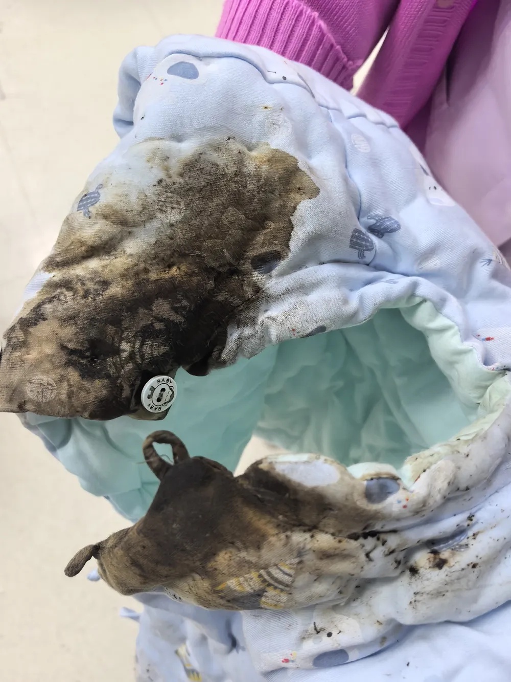 杭州13个月宝宝误触爸爸脚气药粉,头、面部严重灼伤,医生提醒 杭州13个月宝宝误触爸爸脚气药粉,头、面部严重灼伤,医生提醒