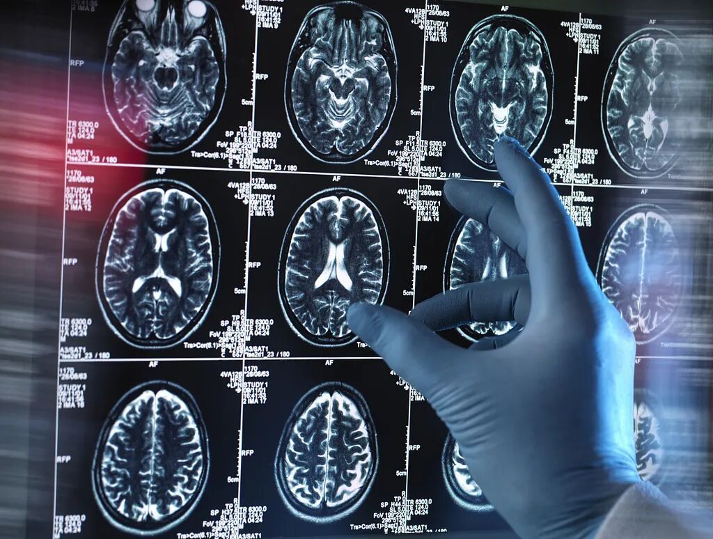 吓懵！00后女生一觉睡醒，嘴！歪！了！硬抗44小时，一查脑中有3颗"炸弹"…