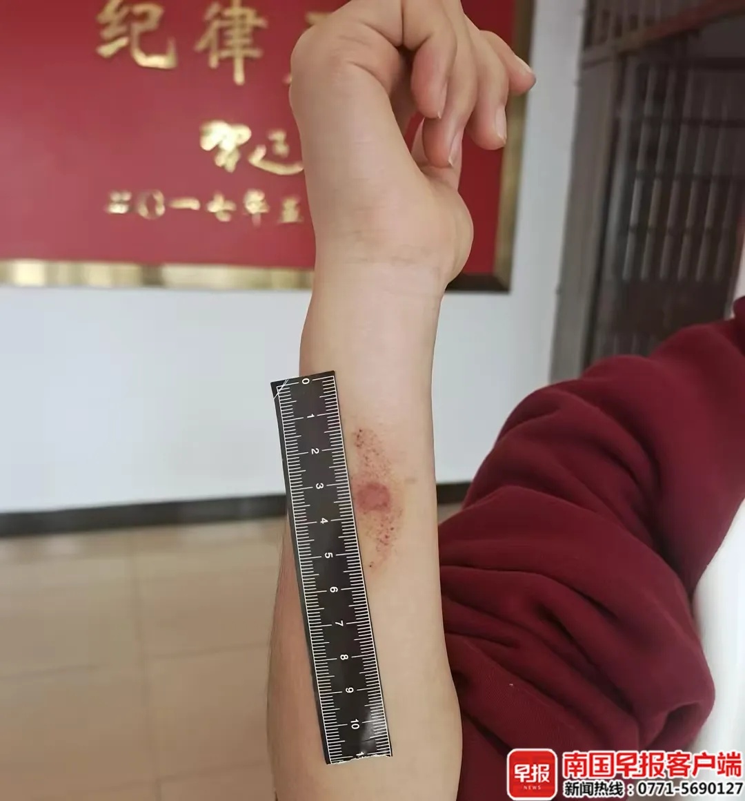 女子未拴狗绳致狗咬伤13岁女孩,贺州警方:行拘5天 女子未拴狗绳致狗咬伤13岁女孩,贺州警方:行拘5天