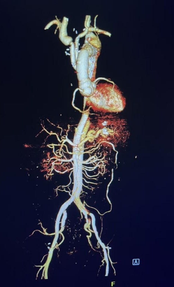 九死一生!男子突发剧痛并伴随下肢运动障碍被判定“无救”,医护上演生命逆转 九死一生!男子突发剧痛并伴随下肢运动障碍被判定“无救”,医护上演生命逆转