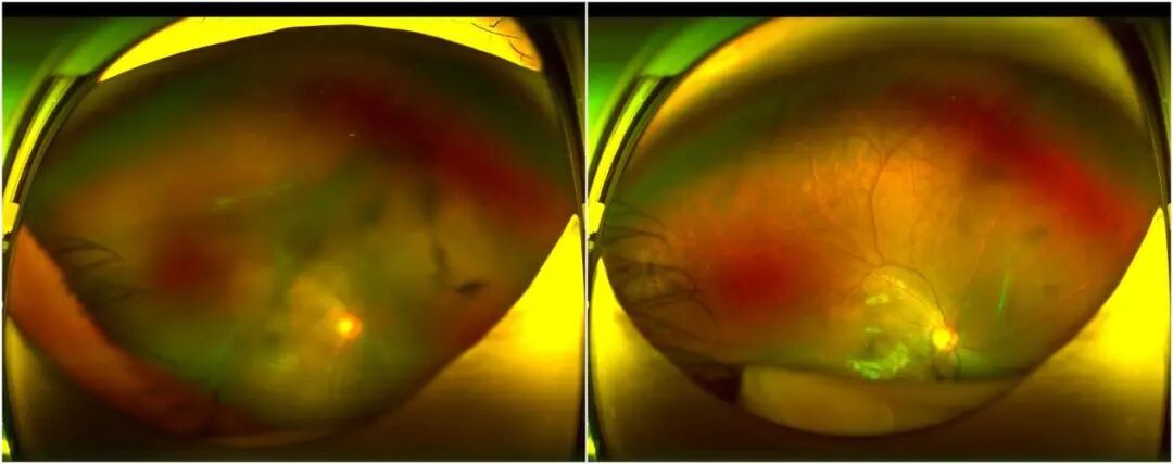 深圳8岁男孩确诊！严重可致失明，这类人群需警惕