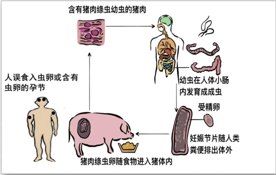 这种饮食习惯危险!女子感染寄生虫多年未治疗 20多年来越吃越瘦 这种饮食习惯危险!女子感染寄生虫多年未治疗 20多年来越吃越瘦