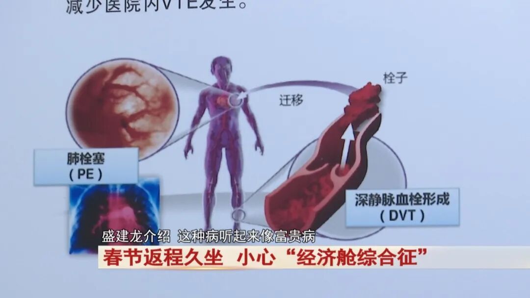 警惕“经济舱综合征”,久坐不动真的会要命! 警惕“经济舱综合征”,久坐不动真的会要命!