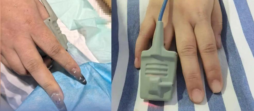 美甲可能误抢救 这些指甲上的“健康警报”你了解吗