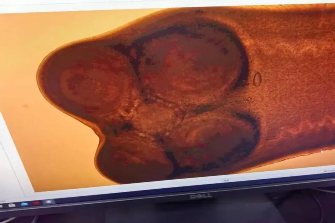 这种饮食习惯危险!女子感染寄生虫多年未治疗 20多年来越吃越瘦 这种饮食习惯危险!女子感染寄生虫多年未治疗 20多年来越吃越瘦