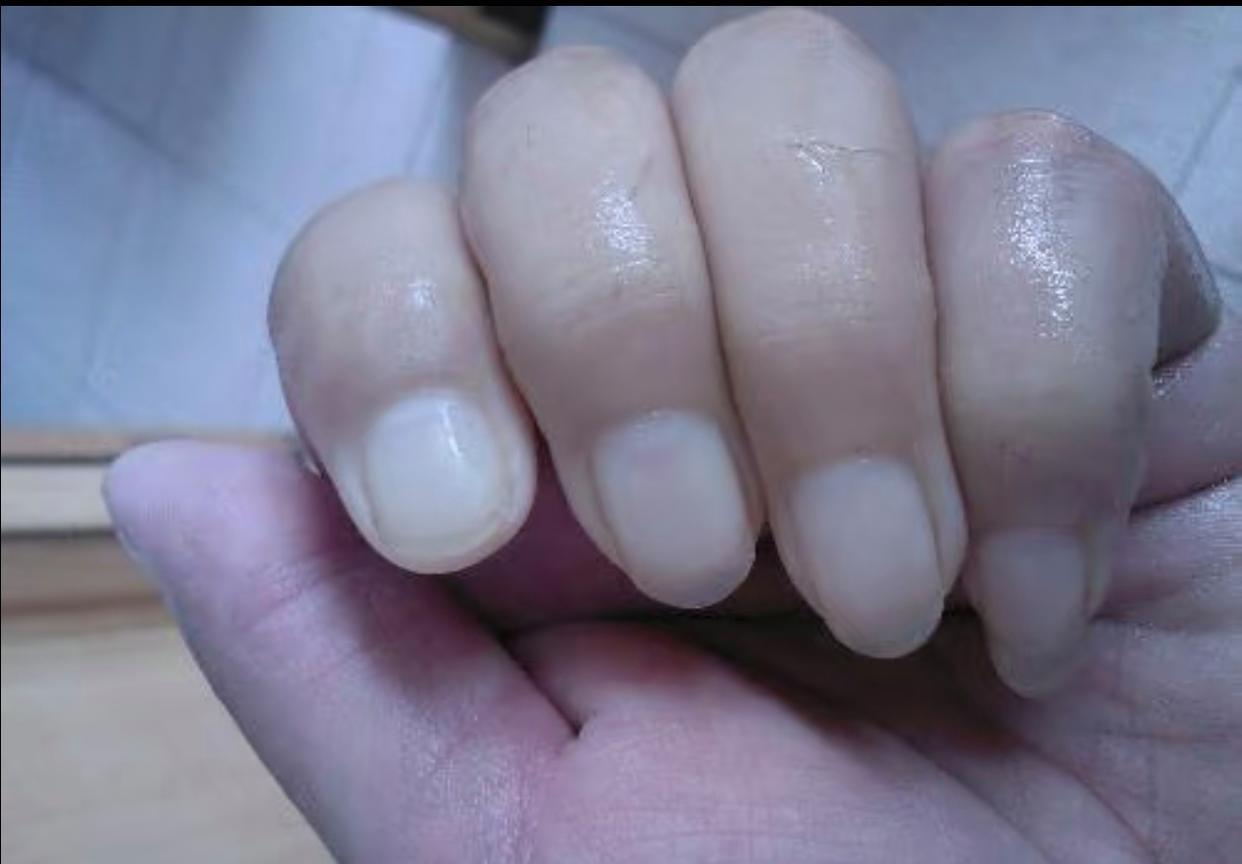 美甲可能误抢救 这些指甲上的“健康警报”你了解吗
