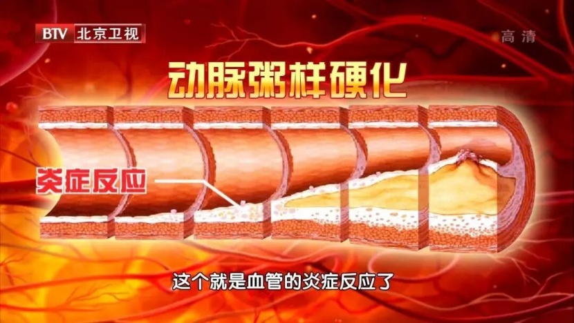 比胆固醇更早的血管斑块“预警信号”，查血脂记得看它
