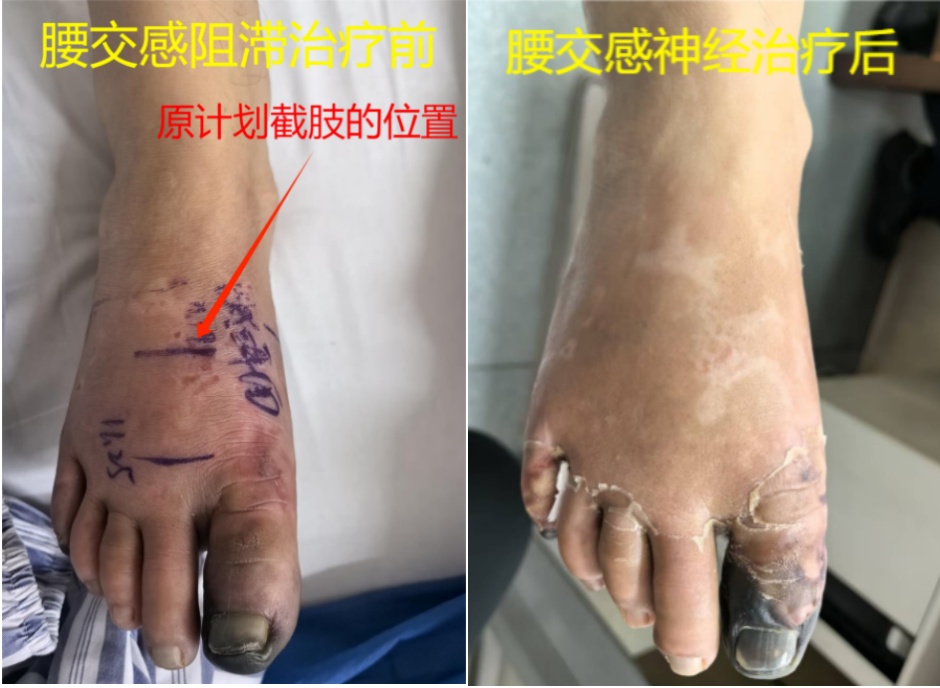 只是脚冷而已，浙江30多岁男子却险遭截肢！很多人都在犯同样错